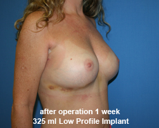 plastic-surgery-breast-augmentation